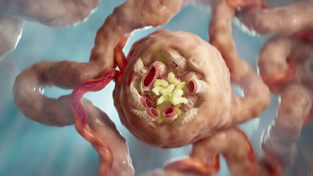 IgAN: Mechanism of disease